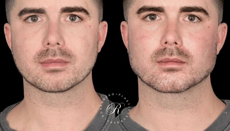 Non-surgical ChinJaw Augmentation RPS Before & After.zip - 27