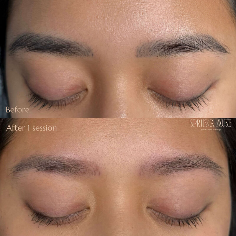 Laser Eyebrows Removal New York