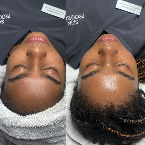 facial before and after photos