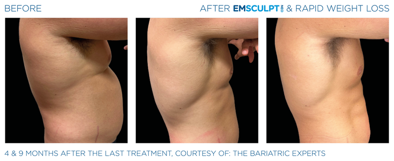 Emsculpt_Neo-Weight-Loss_PIC_Ba-card-male-abdomen-010_ENUS100