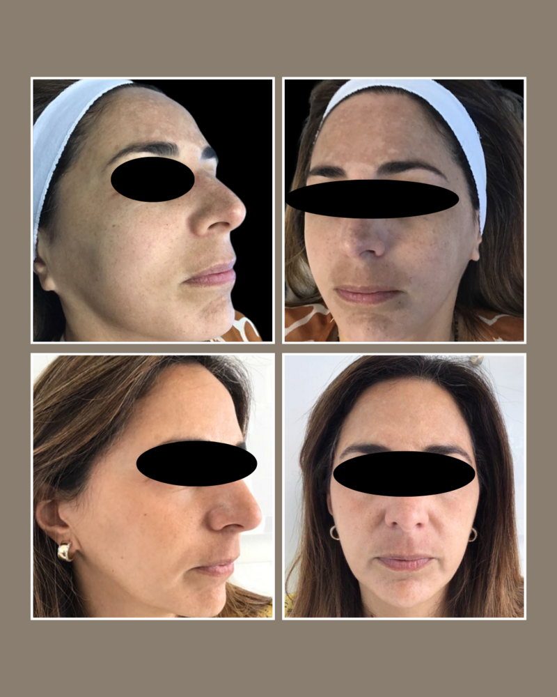 Lasers - Glösense Dermatology and Aesthetics, Miami