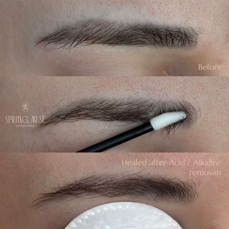 Acid Microblading Removal NYC