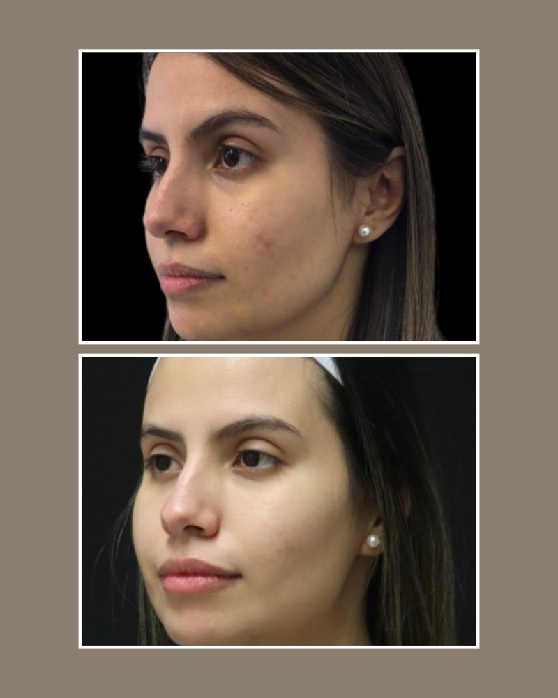 Lasers - Glösense Dermatology and Aesthetics, Miami
