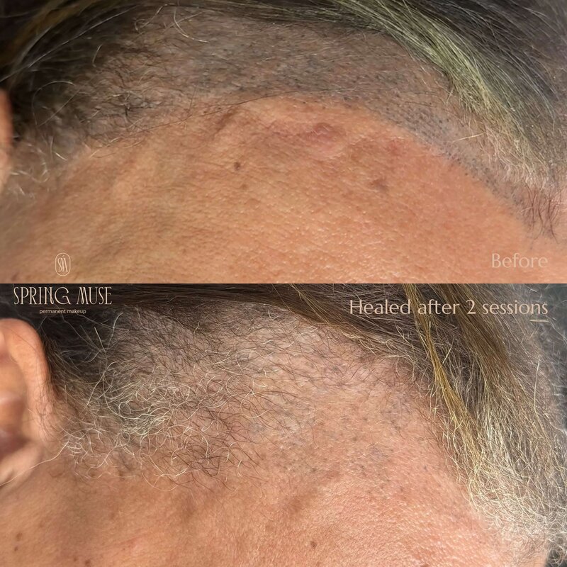 Laser Scalp removal NYC