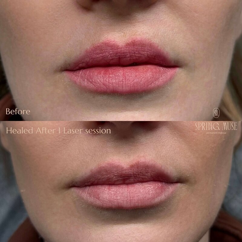 lip blush laser removal New York