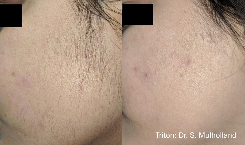 SM_1a_Triton_Face_LR-scaled