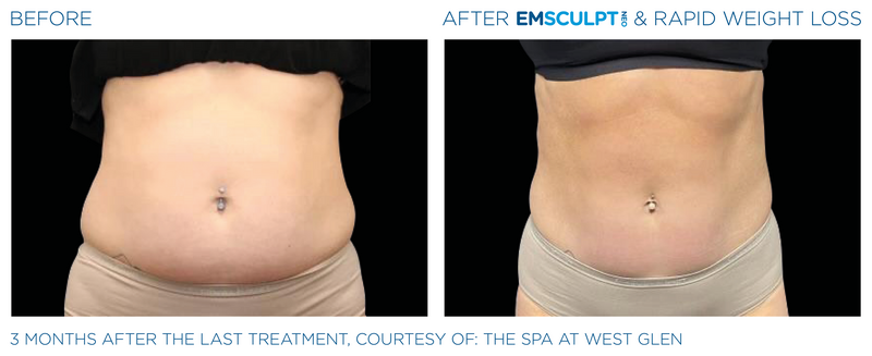 Emsculpt_Neo-Weight-Loss_PIC_Ba-card-female-abdomen-004_ENUS100