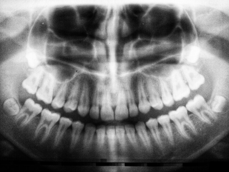 A black and white x-ray of teeth including wisdom teeth.