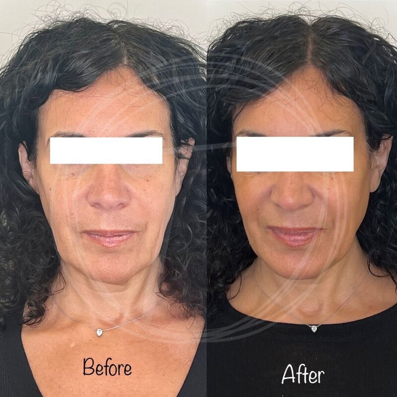before:after results with look timeless- 7