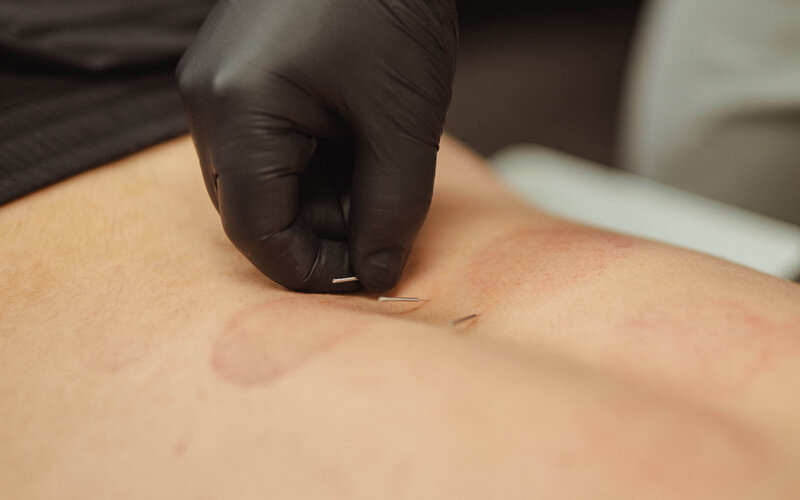 Therapist applying intramuscular stimulation treatment to alleviate muscle pain