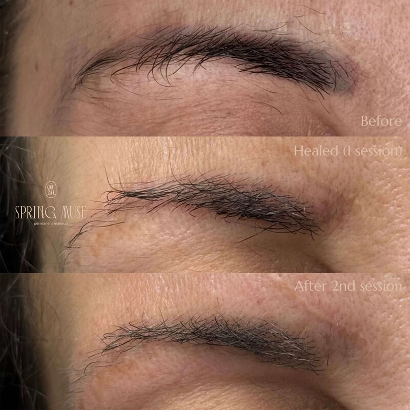 Laser Eyebrows Removal New York
