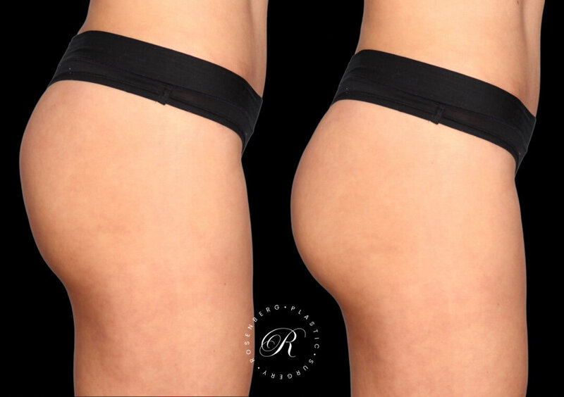 BeverlyBum Before and After