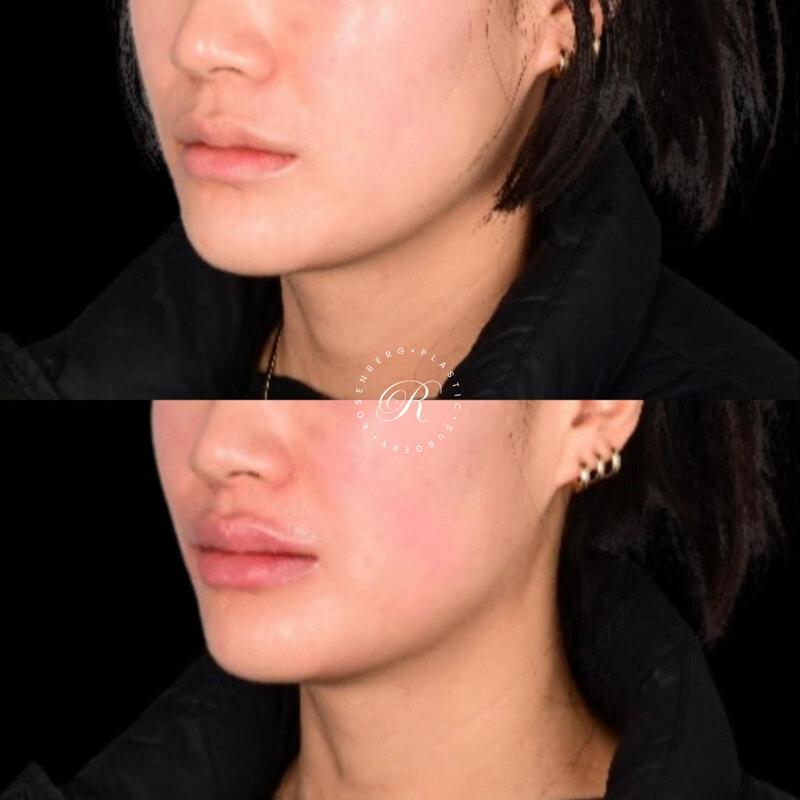 Non-surgical Lip Augmentation RPS Before & Afters.zip - 1