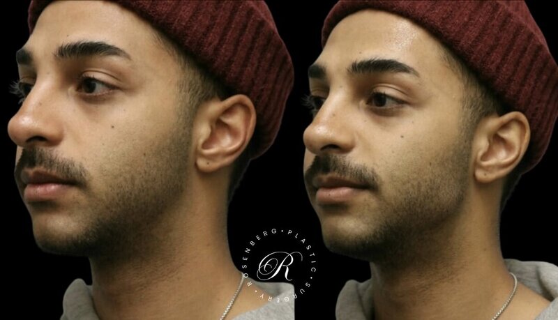 Non-surgical ChinJaw Augmentation RPS Before & After.zip - 11
