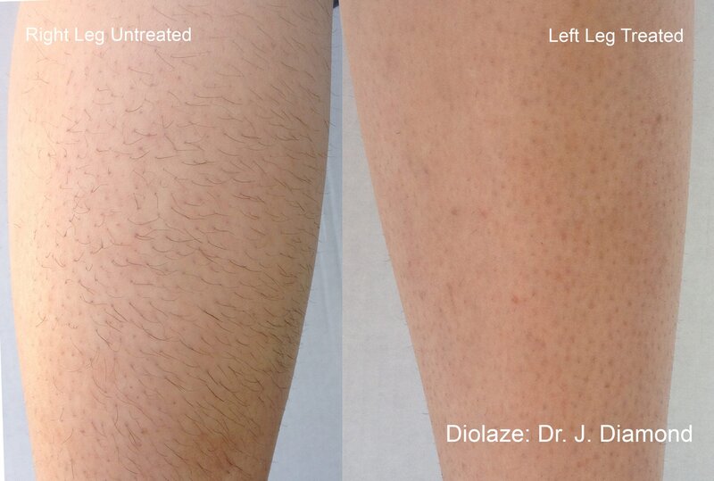 diolazexl-before-after-dr-j-diamond-preview-3 (1)
