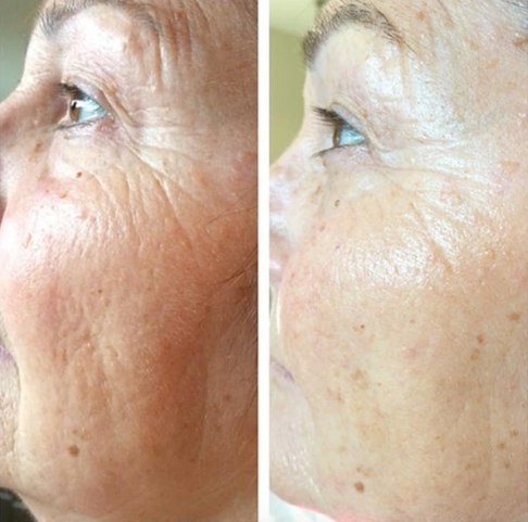 resultats de soins