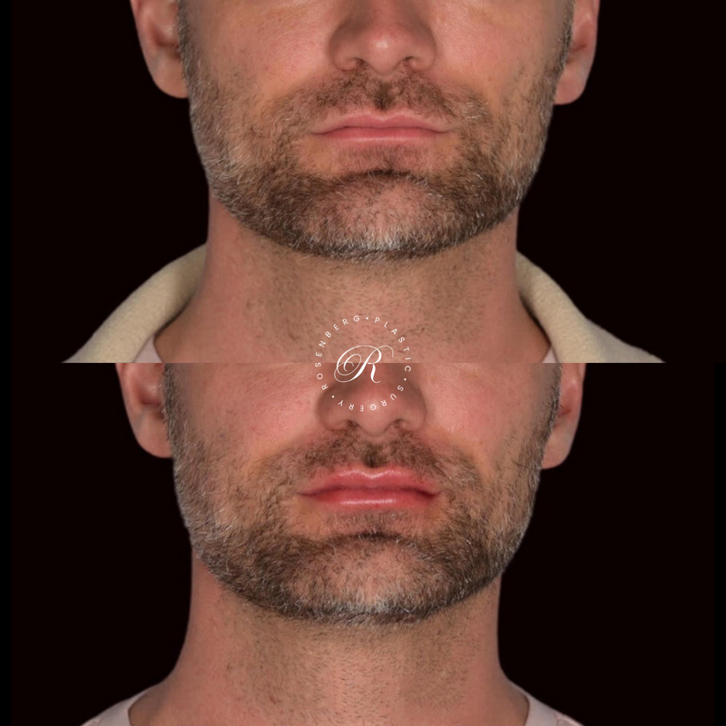 Non-surgical ChinJaw Augmentation RPS Before & After.zip - 55