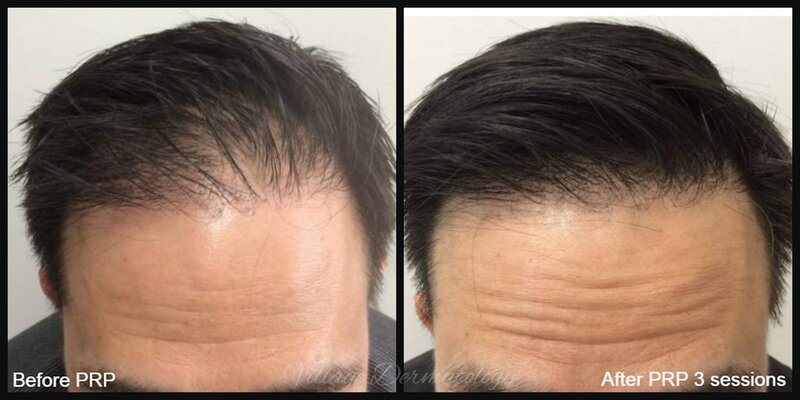 Platelet Rich Plasma Injection Before and After on hair line