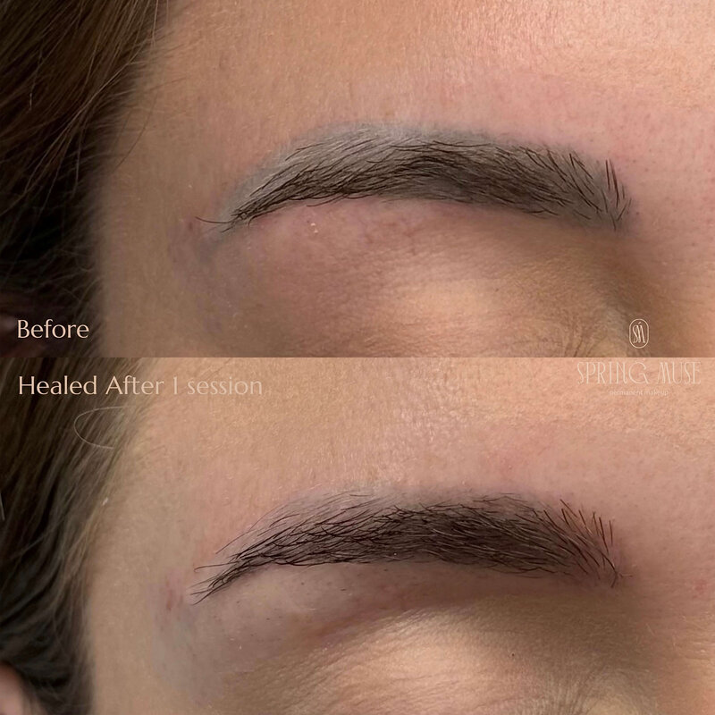 Laser microblading removal NYC