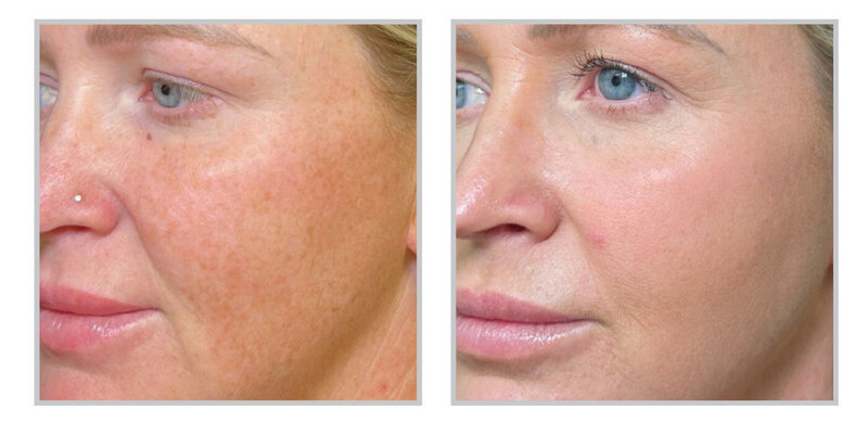 Beauty and Grace Aesthetics Botox patient before and after
