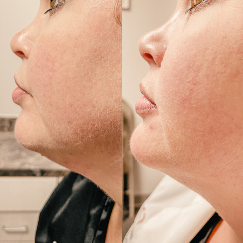 Kybella Treatment in Rockwall TX