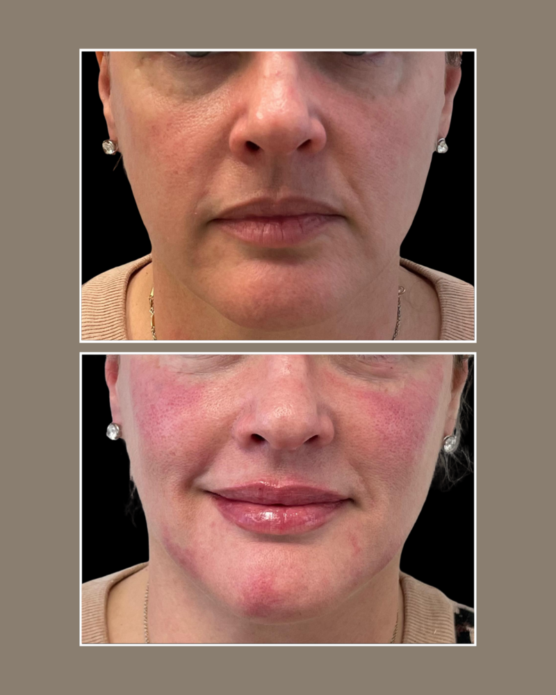 dermal fillers -  Injectables - Glösense Dermatology and Aesthetics, Miami
