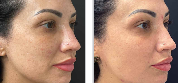 Skin clarity improvement after MOXI laser facial, showing fewer dark spots and enhanced radiance.