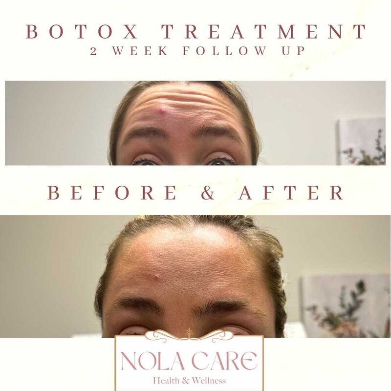 Botox treatment before and after forehead lines