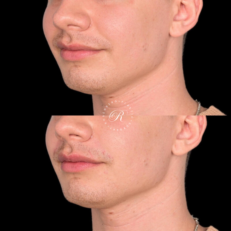 Non-surgical Lip Augmentation RPS Before & Afters.zip - 16