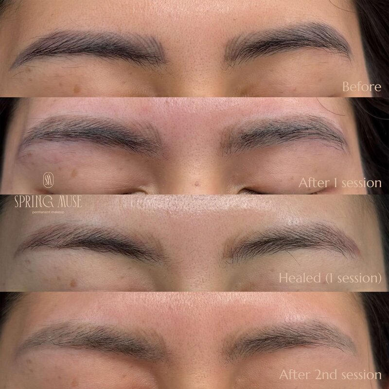 Laser Eyebrows Removal New York