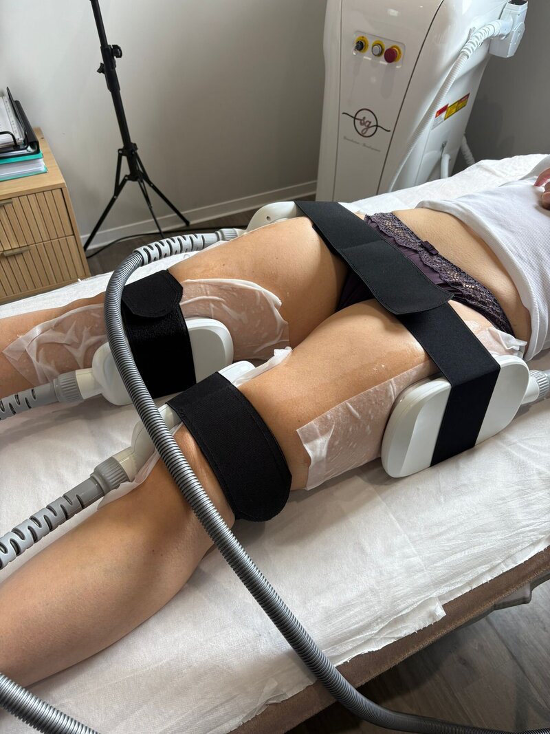 soins Cryolipolyse corps