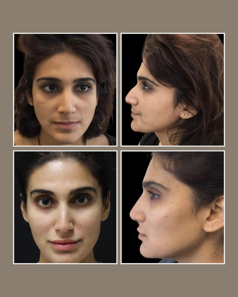 full facial harmonization - Injectables - Glösense Dermatology and Aesthetics, Miami