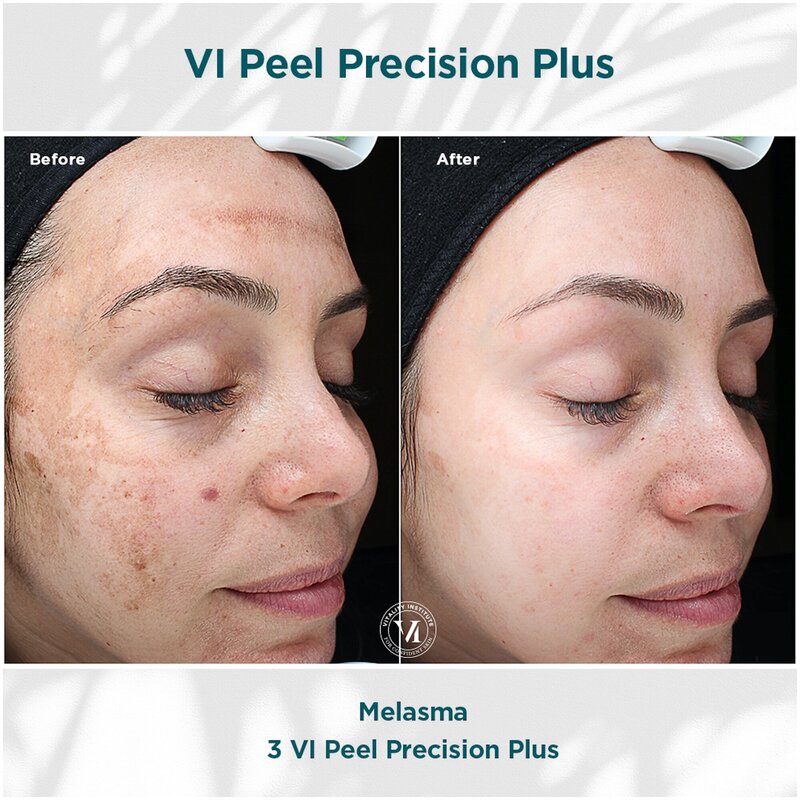 Chemical Peel before and after