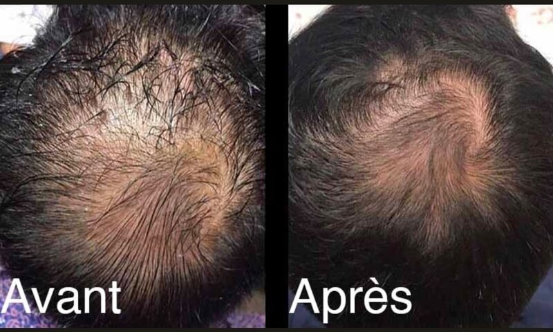 infirmière-esthétique-jet-peel-brignoles