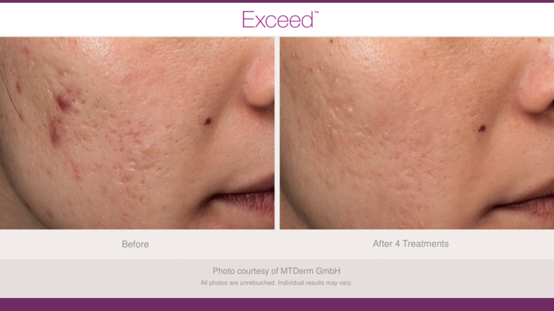 Candela Exceed before and after photo face