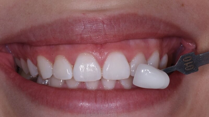 Example 3-After getting the Zoom Whitening treatment