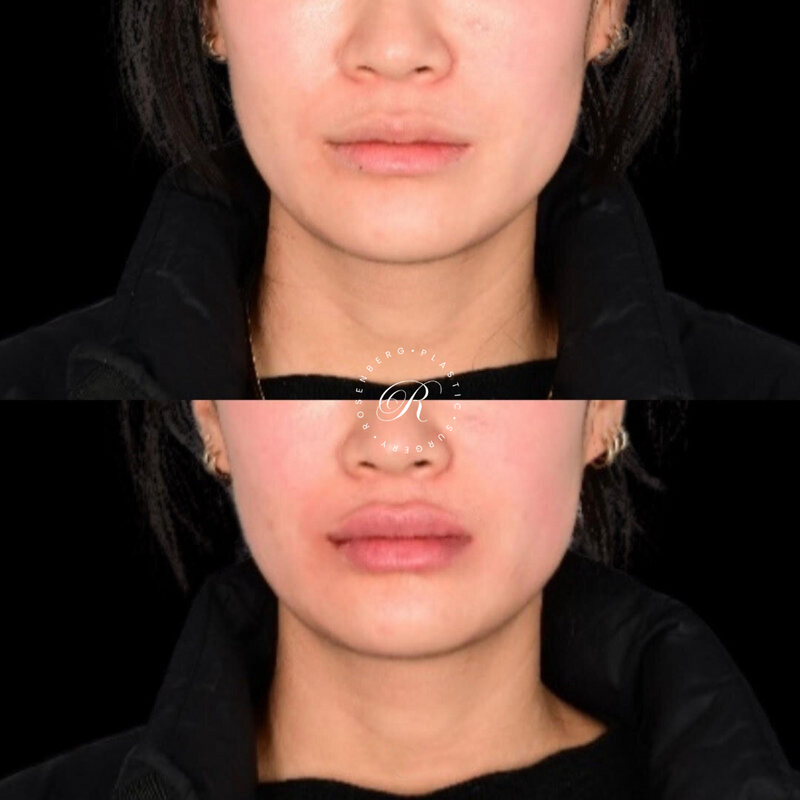 Non-surgical Lip Augmentation RPS Before & Afters.zip - 2