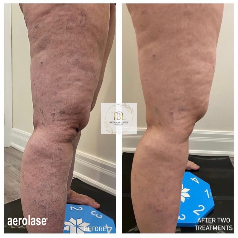 Veins by Aerolase (3)