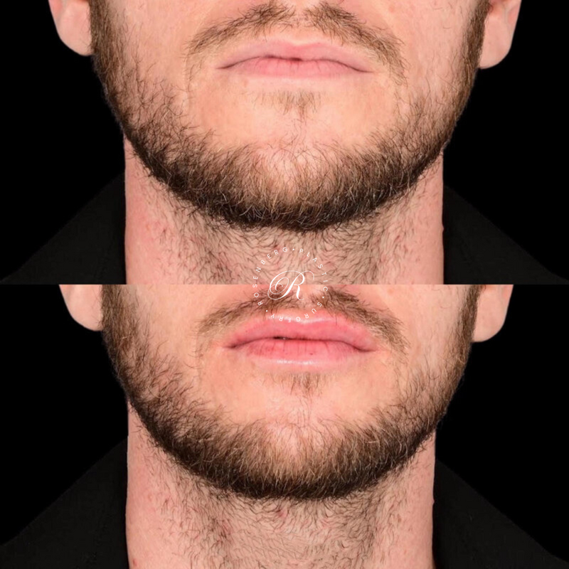 Non-surgical Lip Augmentation RPS Before & Afters.zip - 5