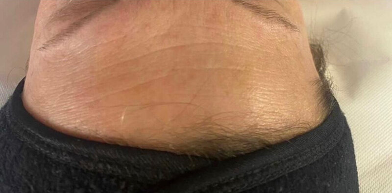 carbonpeel soins esthétique