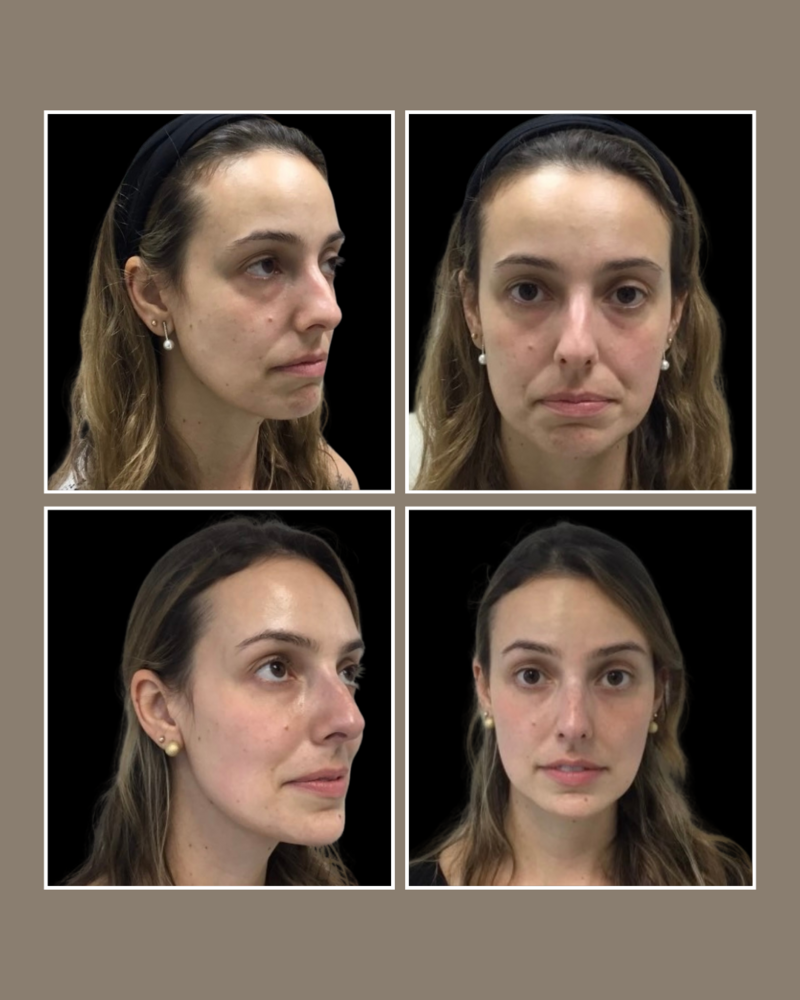 Injectables - Glösense Dermatology and Aesthetics, Miami