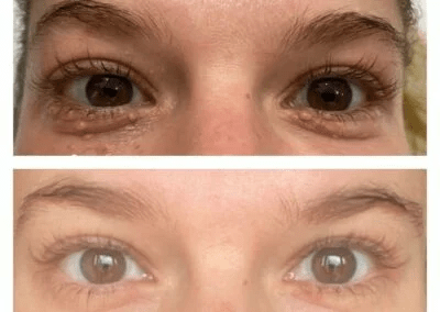 Milia-and-Syringoma-before-and-after-1-400x284 (1)