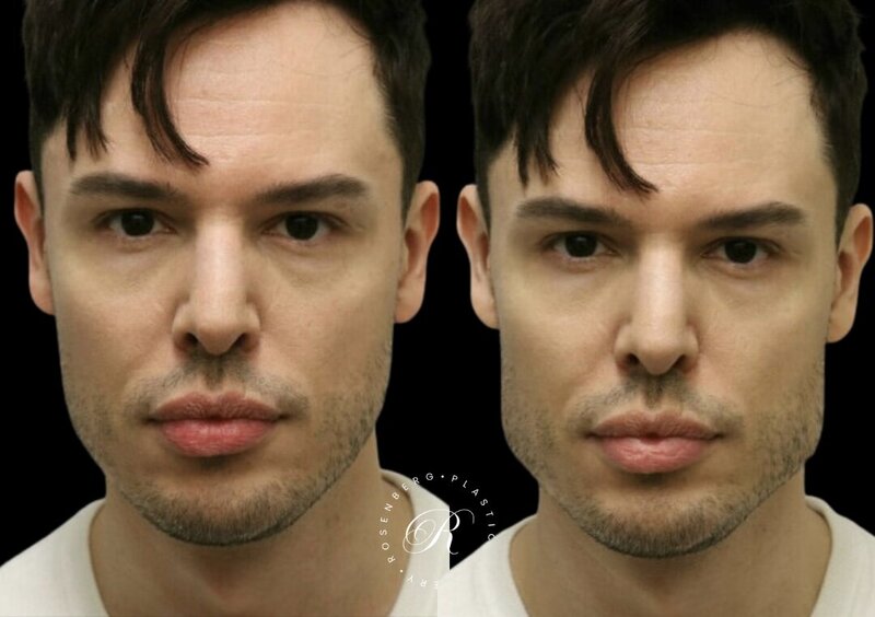 Non-surgical ChinJaw Augmentation RPS Before & After.zip - 17
