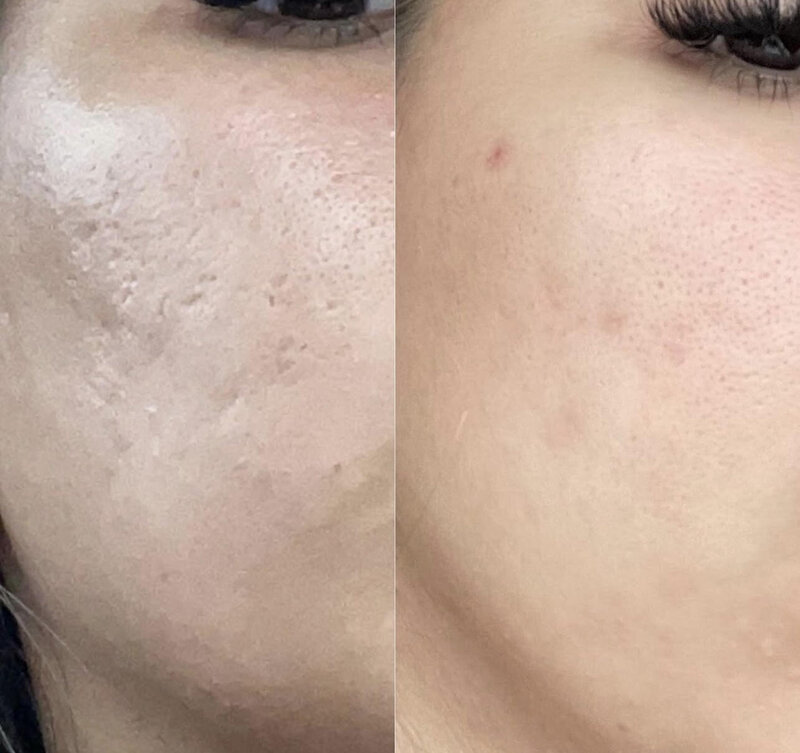 Needling3