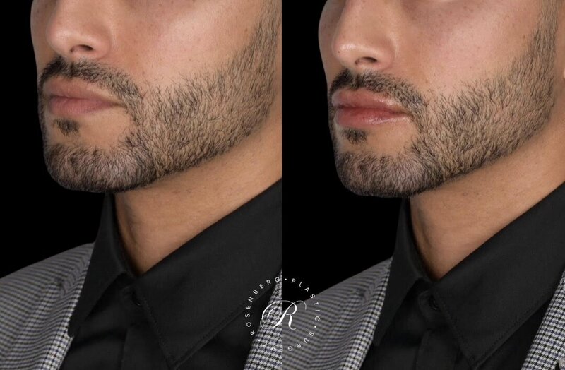 Non-surgical Lip Augmentation RPS Before & Afters.zip - 25