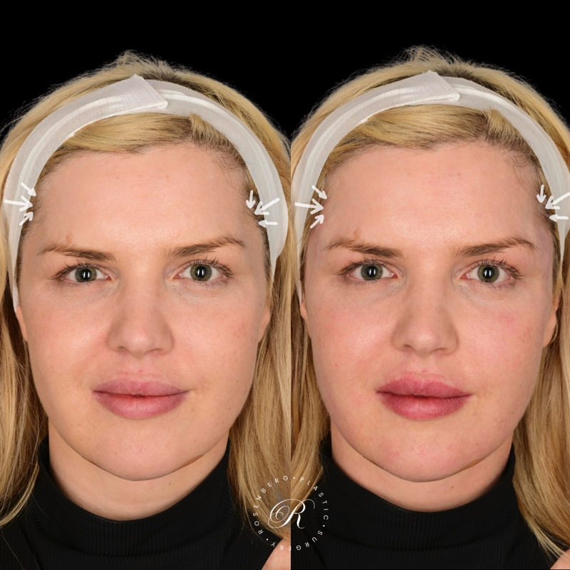 Dermal Fillers to the Temple