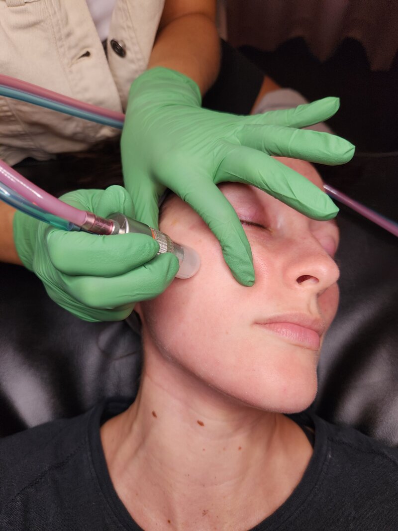 Cleveland microdermabrasion. Berea OH microdermabrasion.