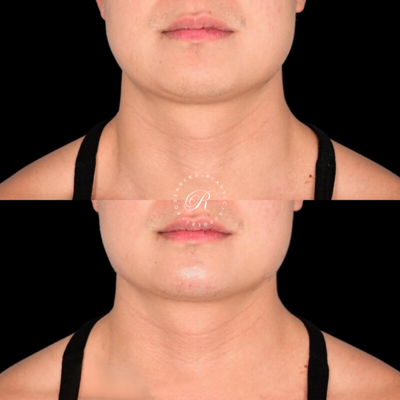 Non-surgical ChinJaw Augmentation RPS Before & After.zip - 41