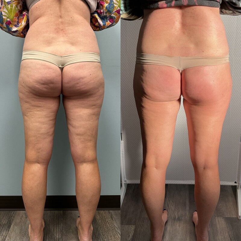 After-3-treatments-back