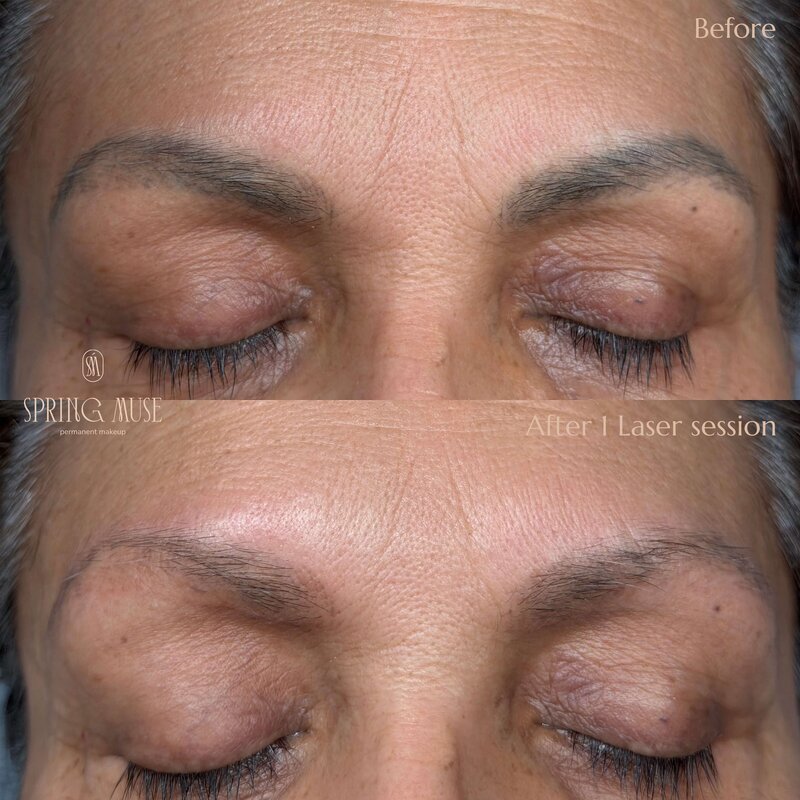Laser Eyebrows Removal New York